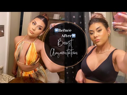 My Breast Augmentation Experience