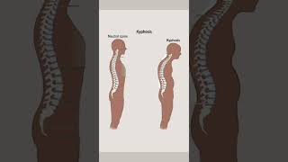 Spine Normal Vs Abnormal.