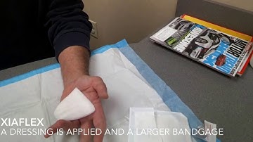 Xiaflex for Dupuytren