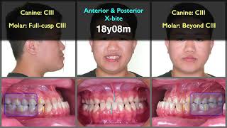 Skeletal Class III with posterior crossbite｜【Chris Chang Ortho】CC749