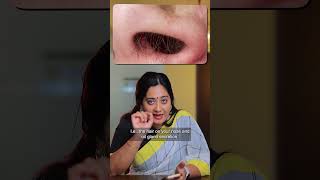 Best Solution For Black Heads On Nose | Dr Shwetha Rahul