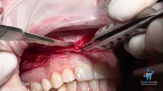 Surgical Lip Repositioning