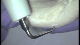 Customizing Ultrasonic Tips from EIE2