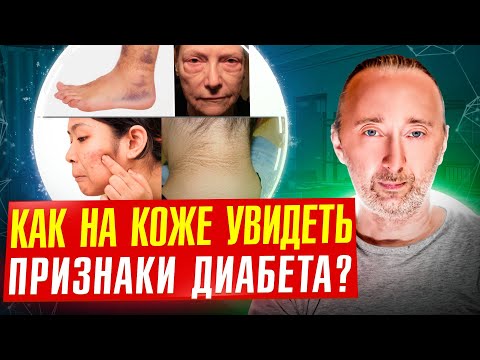 Ваша КОЖА точно укажет на Сахарный Диабет 2 типа! Причины и лечение диабета! Отличие 2 от 1 типа!