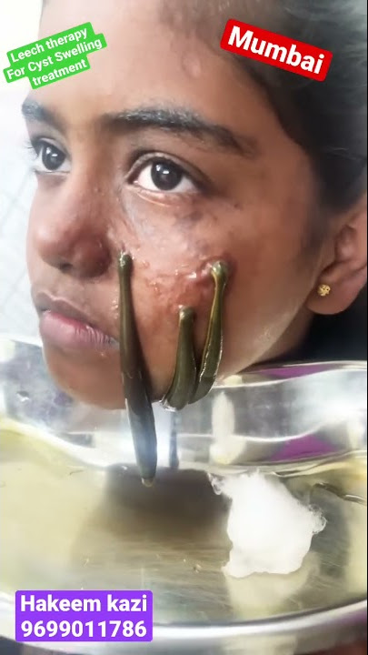 Is leech therapy good for face? - What is a cosmetic leech? / #leechtherapy#leech#ayurveda#youtube