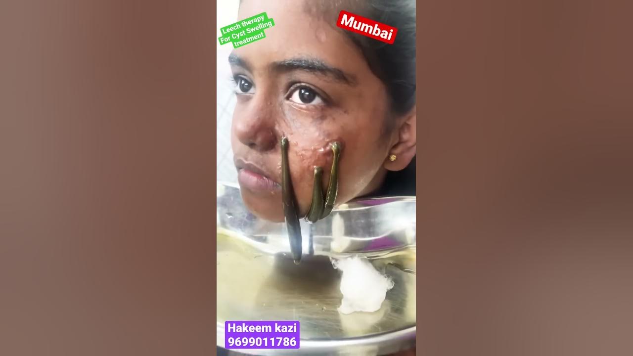 is-leech-therapy-good-for-face-what-is-a-cosmetic-leech