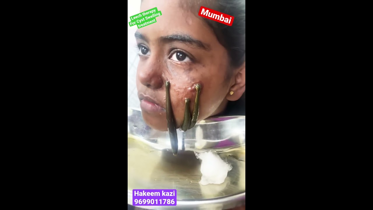 Is Leech Therapy Good For Face What Is A Cosmetic Leech Is Leech Therapy Good For Face What Is A Cosmetic Leech