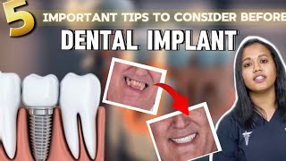 Dental Implants Tamil | Everything You Need to Know 5 Important Tips