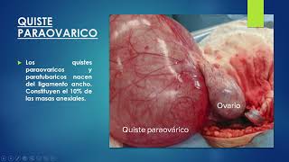 LESIONES DEL OVARIO PARTE I