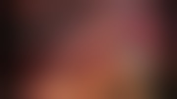 Full Robotic Isolated Caudate Lobe Liver Resection for Hepatocellular Carcinoma