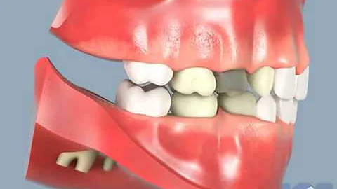 Dental Crows - Jupiter, FL | Dentist Dr. Michael S...