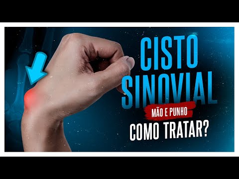 Vídeo: Um cisto mucoso é um cisto ganglionar?