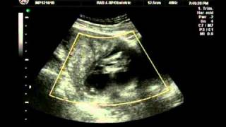 Baby Parker Gender Determination Ultrasound