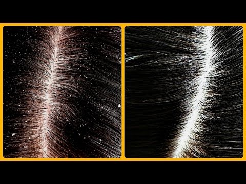 Magical Cure For Dandruff & Hair Fall /Home Remedies For Dandruff | Dandruff रूसी से छुटकारा