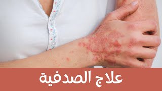 3 Natural Treatments For Psoriasis ثلاث وصفات سهلة وطبيعية لعلاج الصدفية الخفيفة | النتيجة بعد اسبوع