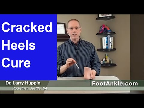 How to Treat Dry Cracked Heels with Seattle Foot Doctor Larry Huppin