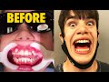 Getting My Braces Off... YES it HURT!