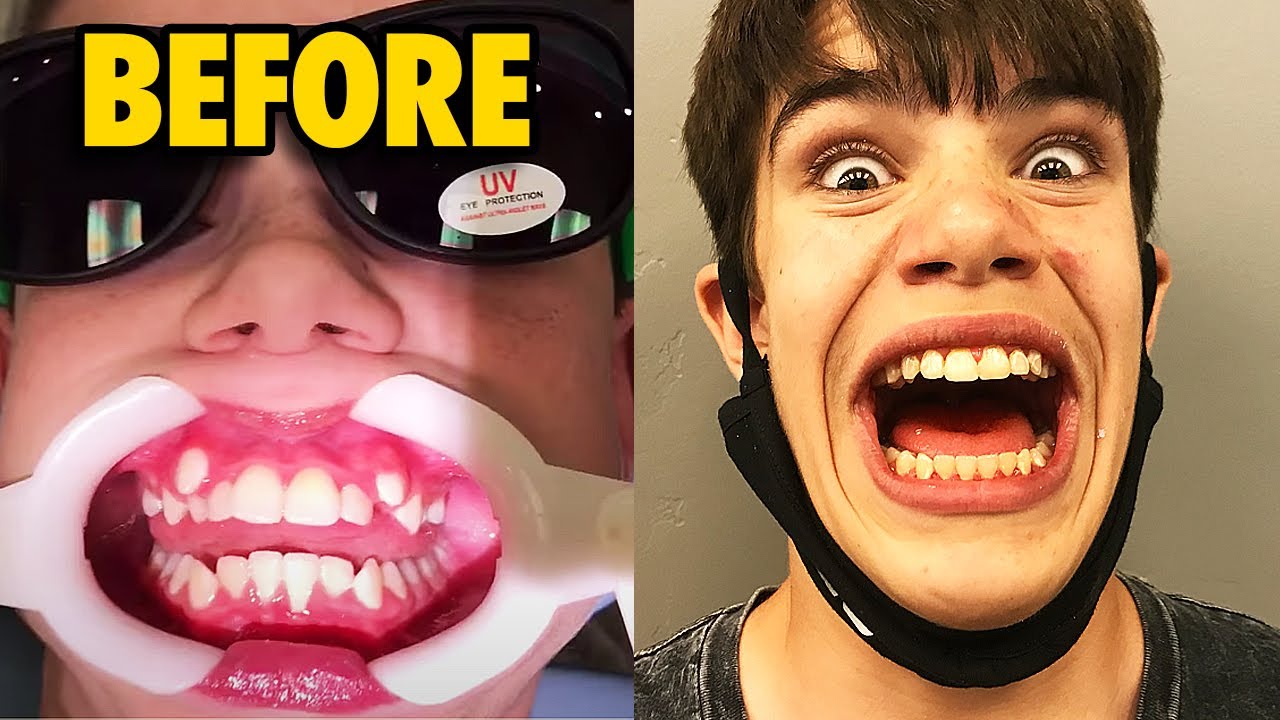 Getting My Braces Off... YES it HURT! - YouTube