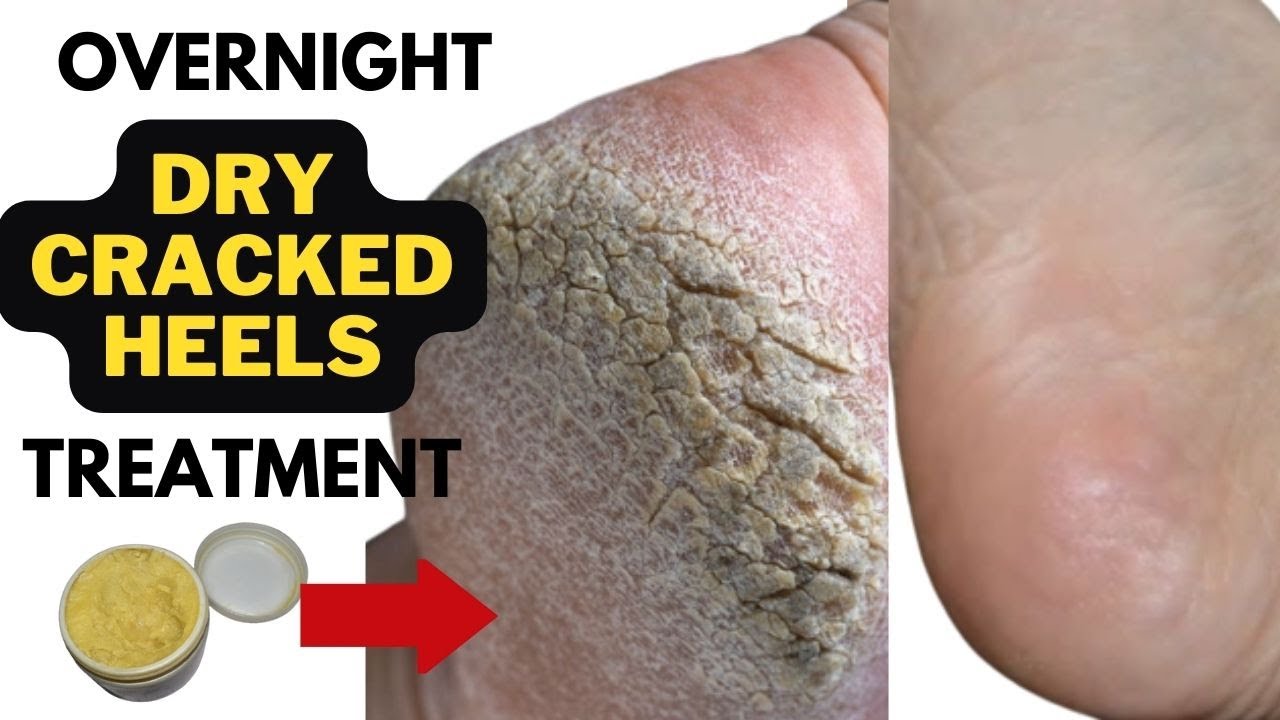 Cracked Heels: Causes, Symptoms & Treatment | The Feet People Podiatry