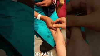 Carpal Spasm in Hypocalcemia: Trousseau Sign #Hypocalcemia #TrousseauSign #CarpalSpasm #Neurology