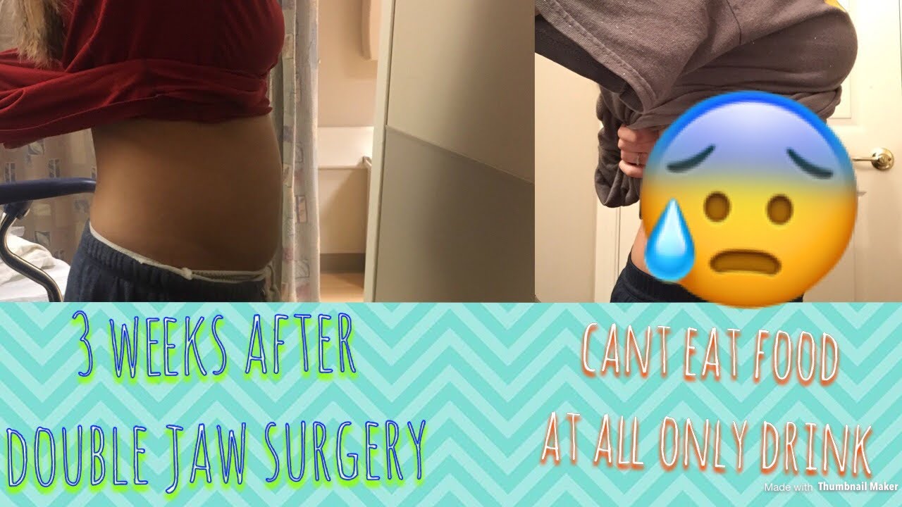 camera iphone 8 plus apk My 3week weight loss journey after jaw surgery !!!