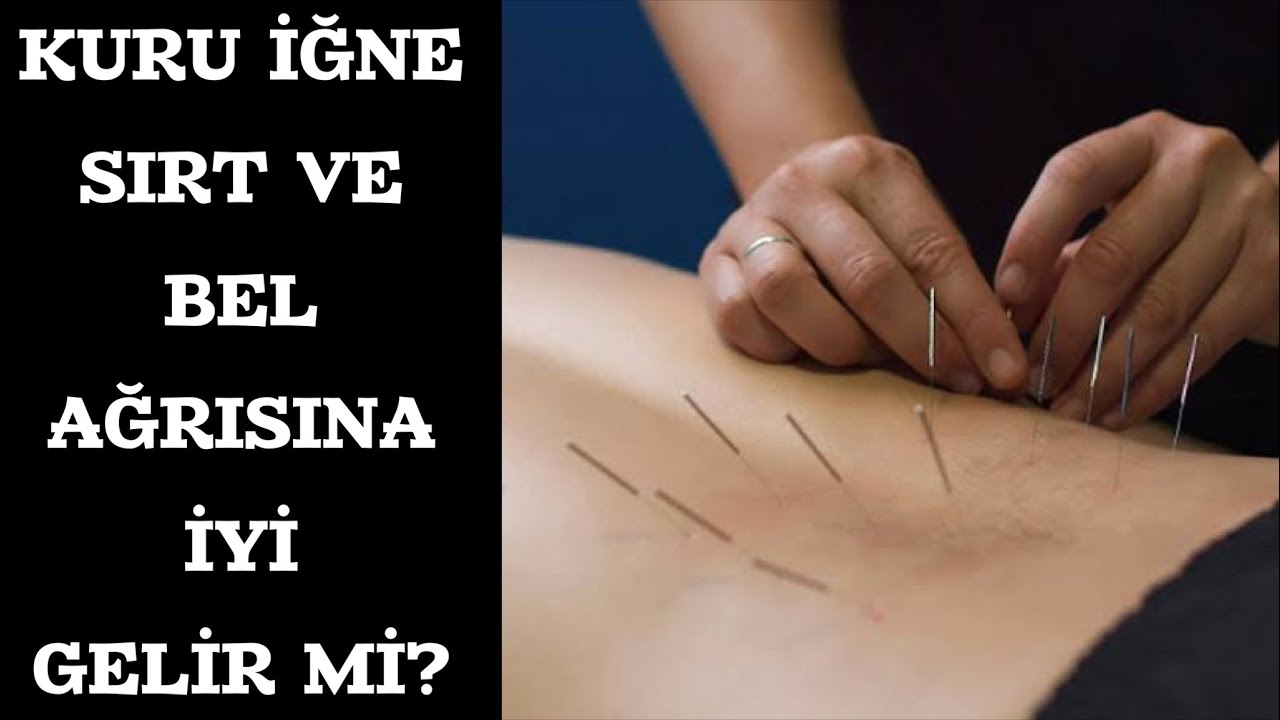 KURU İĞNE GERÇEKTEN İŞE YARIYOR MU? Akupunktur ve Kuru İğnelemenin Farkı Ne?