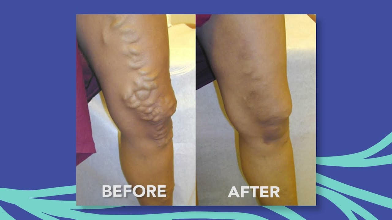 Vein911® Vein Treatment Centers, Tampa, Florida | 