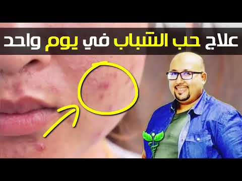 افضل 6 وصفات لازالة حب الشباب بدون اي علامات بمسكات طبيعية من المنزل. 