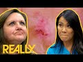 Frustrated Patient Disagrees With Dr. Lee's Diagnosis! | Dr. Pimple Popper