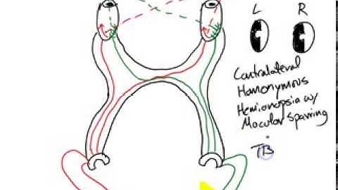 USMLE Review - Neurology (Visual Lesions)
