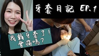 牙套日記EP.1 | 形象崩壞的戴牙套過程紀錄| 戴牙套會痛嗎？最 ...