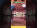 Removal of permanent stains from teeth      #bestdentistinaligarh #bestcosmeticdentist