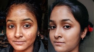 Best Medicine For remove Acne/Pimple#skintransformation #pimpleremoval #rupshadas