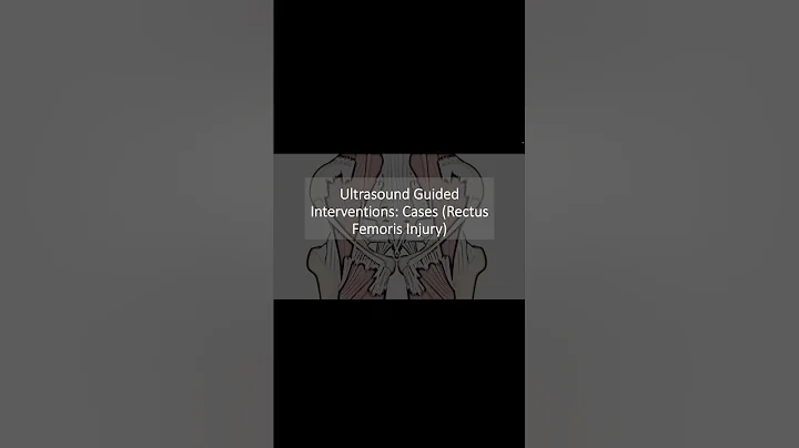 Ultrasound Guided Interventions: Cases (Rectus Femoris Injury) #ultrasound