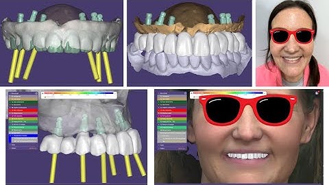 Photogrammetry Conversion of Maxillary Denture to FP1 Full Arch Implant Restoration