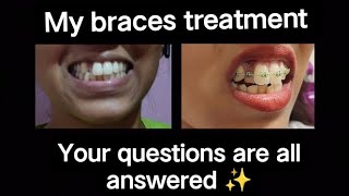 My Braces Journey till now crossbite | bracesupdate | orthodontist | noextractions | IPR