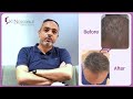 Hair PRP I Hair Regrowth I Dr. Vohra's Skin Clinic