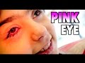 WORST PINK EYE EVER? | Dr. Paul