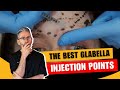 Injecting the glabella injection points  safety advice