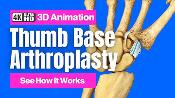 How a Tendon Can Replace an Arthritic Thumb Joint: Thumb Base Arthroplasty