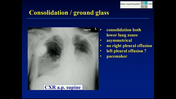 Lung Cancer: unusual presentations - Stefan Dieder...