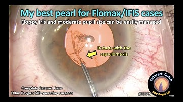 CataractCoach 1372: my best pearl for IFIS / floppy iris / Flomax cataract surgery