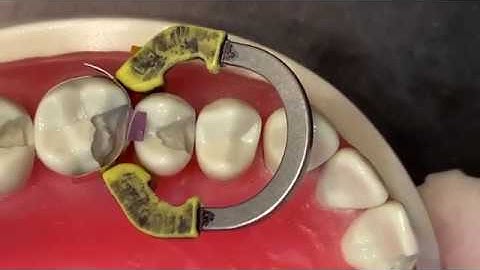 BurtonBands - VursaWedge Broken Cusp Demonstration