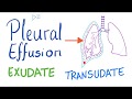 Pleural Effusion; Transudate or Exudate | Pulmonology