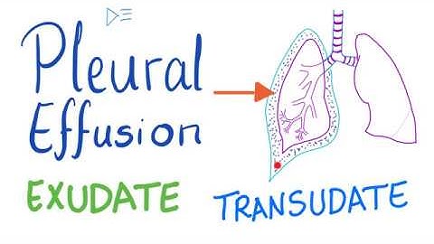 Pleural Effusion - Transudate or Exudate - Causes and Liddle’s Criteria -Pulmonary Medicine Playlist