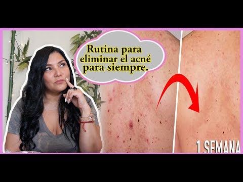 Elimina el acné de la espalda en  días con esta sencilla rutina. % efectivo.