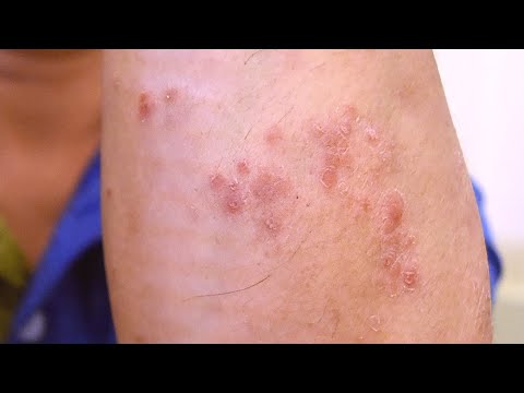 The Secret to Successful Psoriasis Treatment (Part 4/4) | HoaiXuanDuong.com