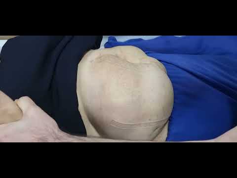 Böyük ölçülü residiv postoperasion qarın yırtığı.Ramil Nadirov. Abdominoplastika. Yırtıq əməliyyatı