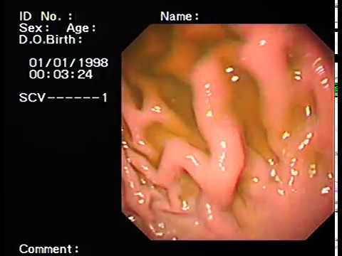 Bile reflux#