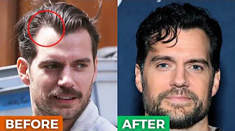 5 BRILLIANT Hairstyles To HIDE A Receding Hairline/Widows Peak